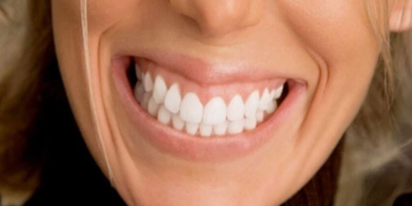 Things to know if you are getting a dental implant