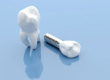 6 Reasons Why Dental Implants are Must?