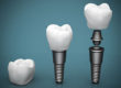 Benefits of Dental Implants