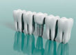 What are the Advantages of Dental Implants?