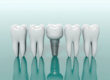 What to do after Dental Implant?